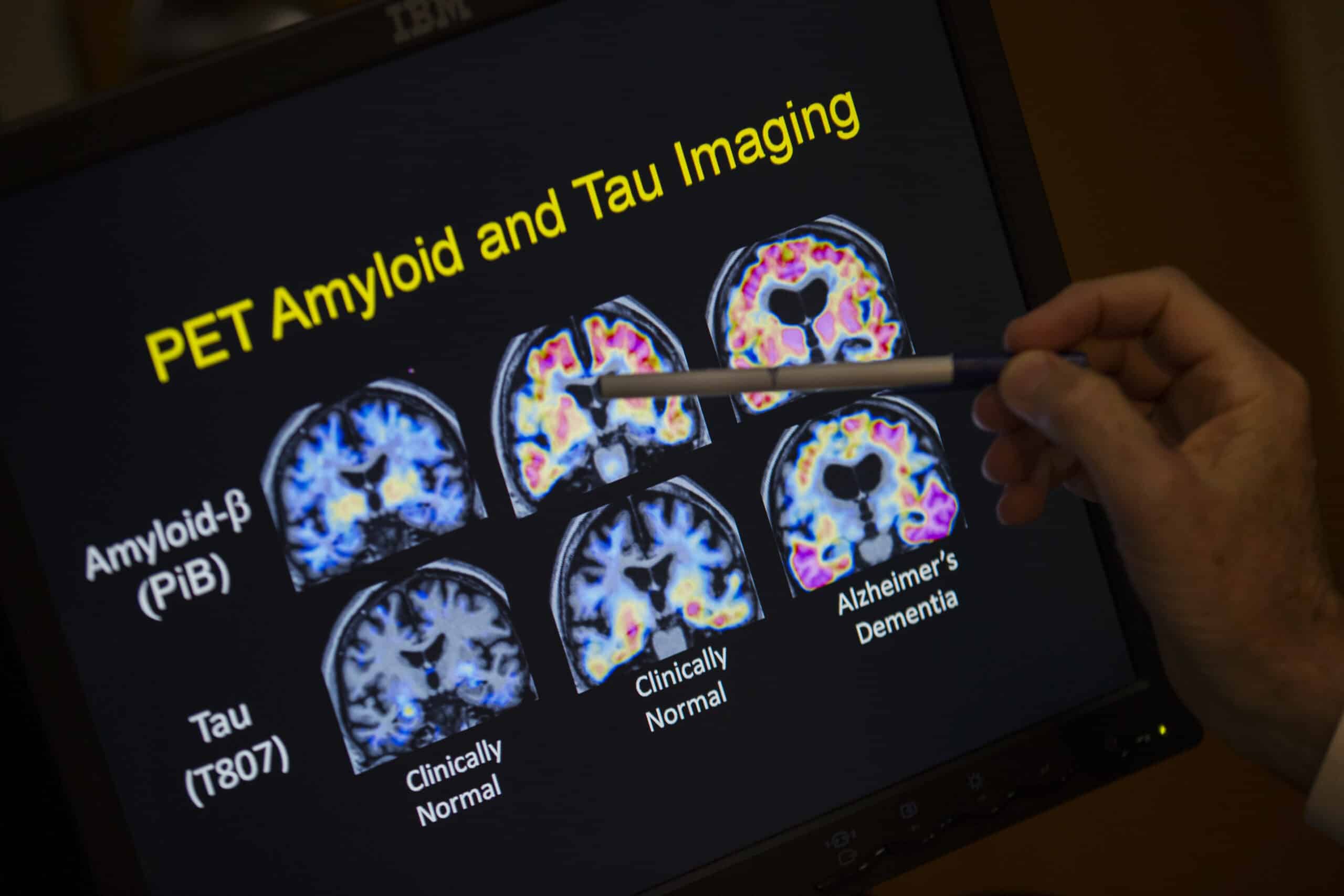 A doctor points to PET scan results that are part of a study on Alzheimer's disease at Georgetown University Hospital