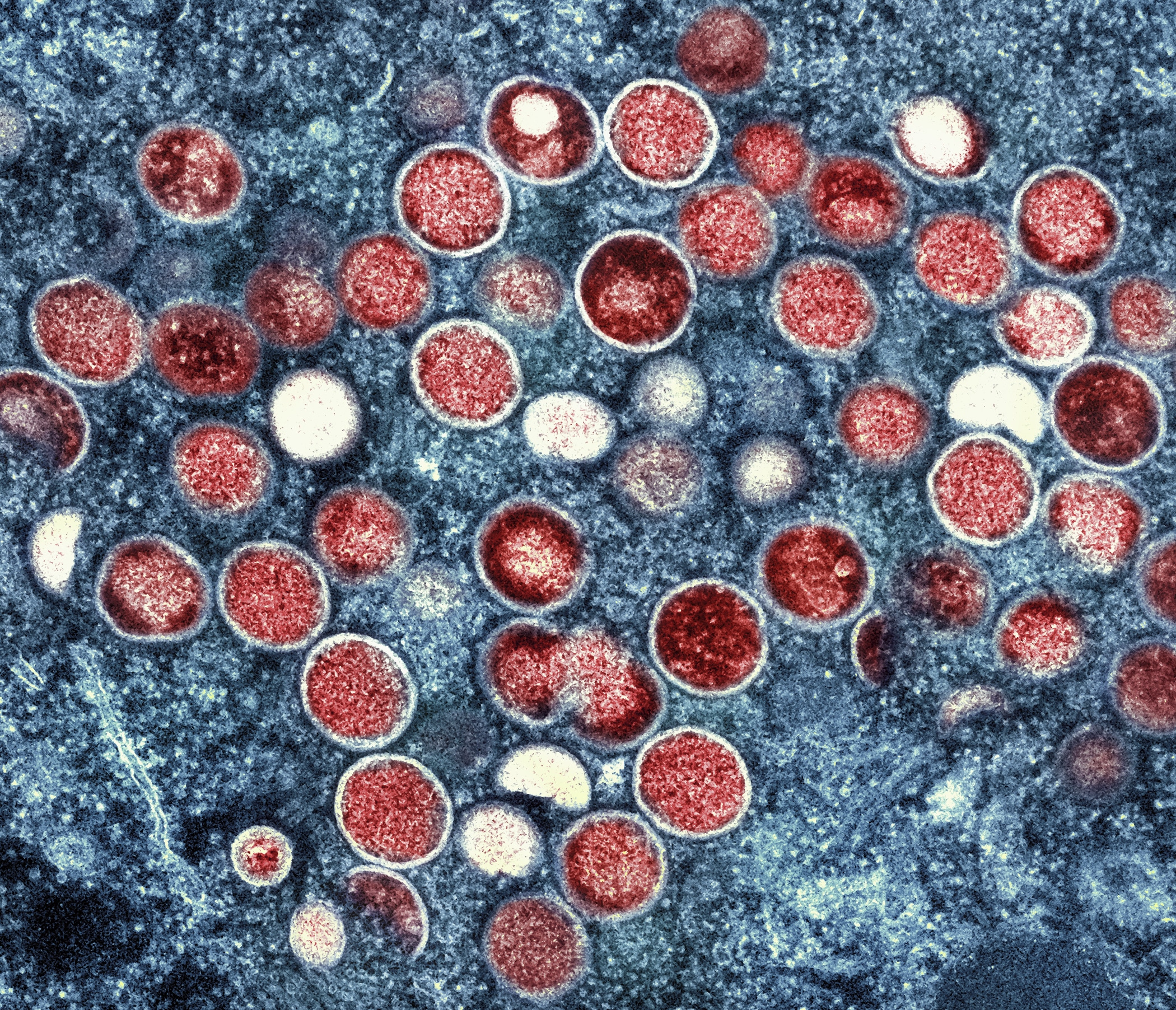 First case of new mpox variant detected in Germany