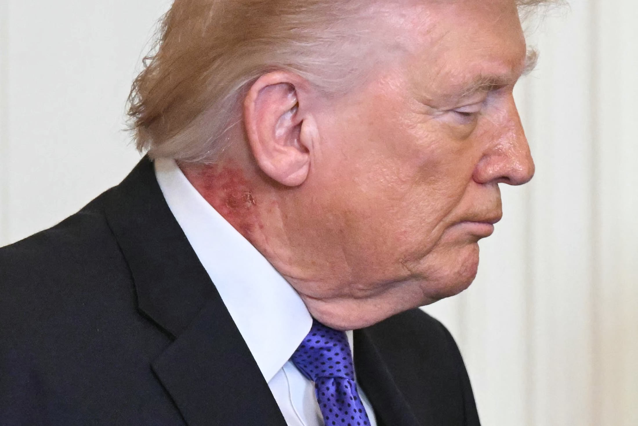 Trump appears with red rash on neck